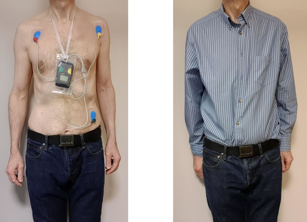 Ambulatory ECG (Ambulatory Electrocardiogram)